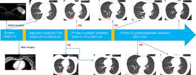 Partial Response After Toripalimab Plus Anlotinib for Advanced Metaplastic Breast Carcinoma: A Case Report